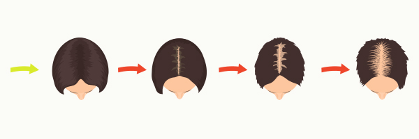 alopecia-femenina-androgenetica-dermatologo-tratamiento-barcelona