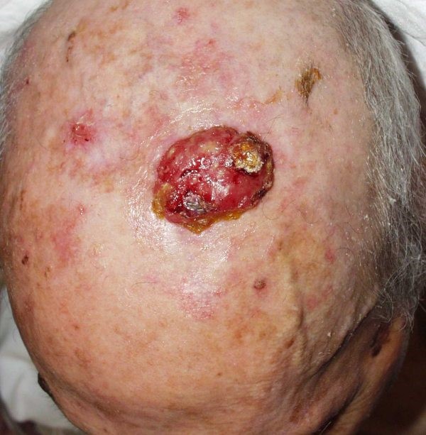carcinoma_escatos_cancer_pell_dr_lopez_barcelona_dermatoleg